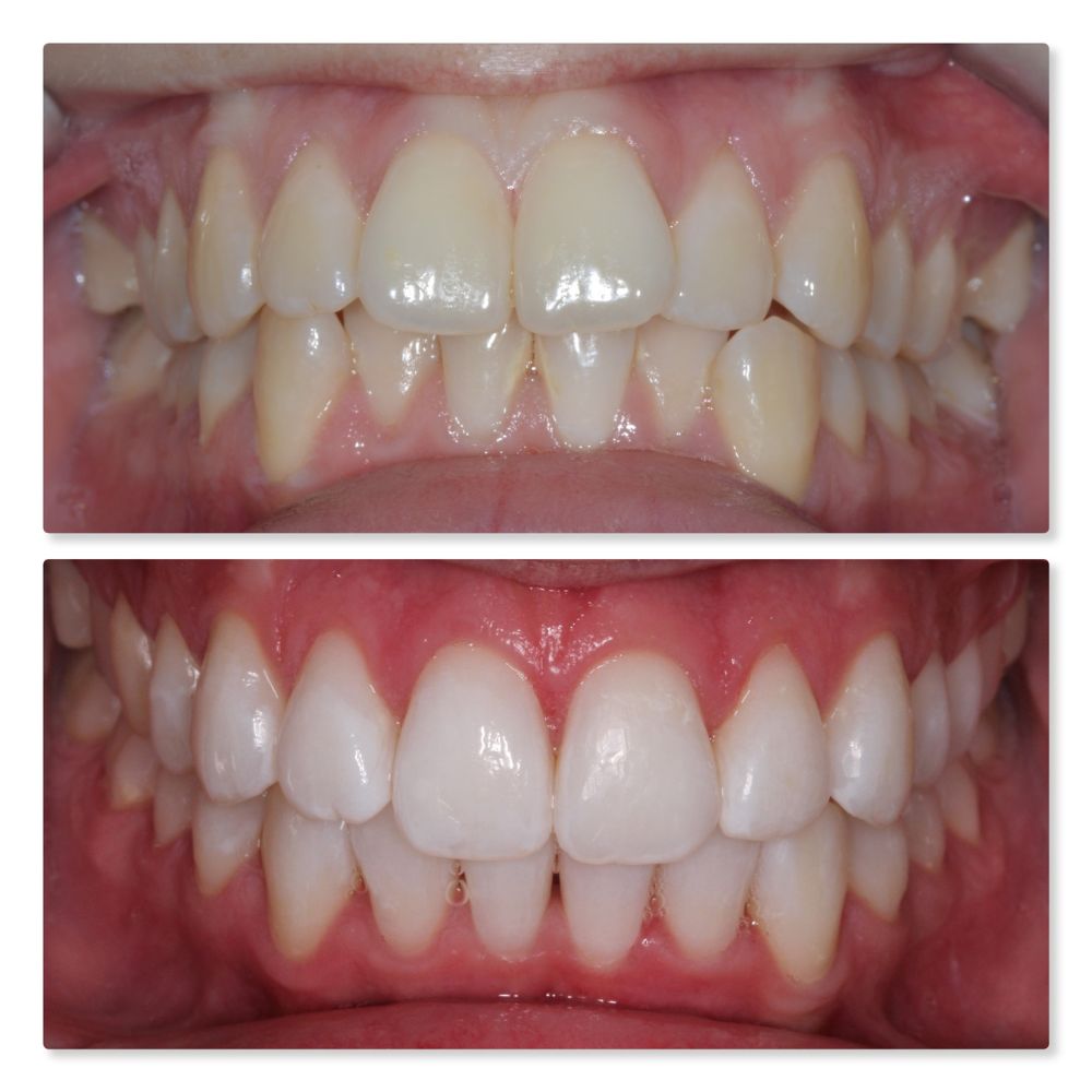 Whitening-5