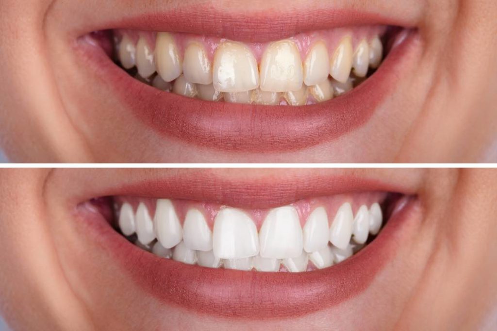 Two-photos-of-before-and-after-teeth-whitening-1024x682-1-1